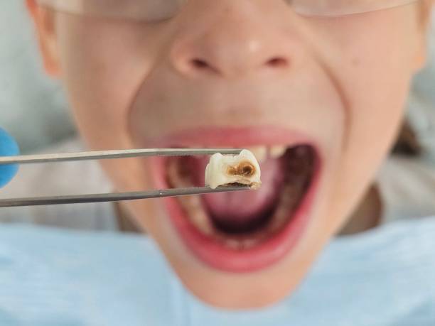 Best Cracked Tooth Emergency Dentist  in Bucyrus, OH