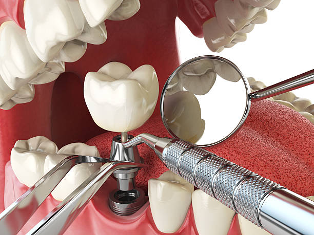Best Emergency Dental Filling Replacement  in Bucyrus, OH